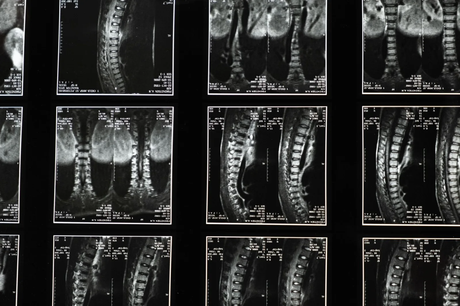 Detectan astrocitos ligados a enfermedades neurológicas
