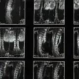 Detectan astrocitos ligados a enfermedades neurológicas