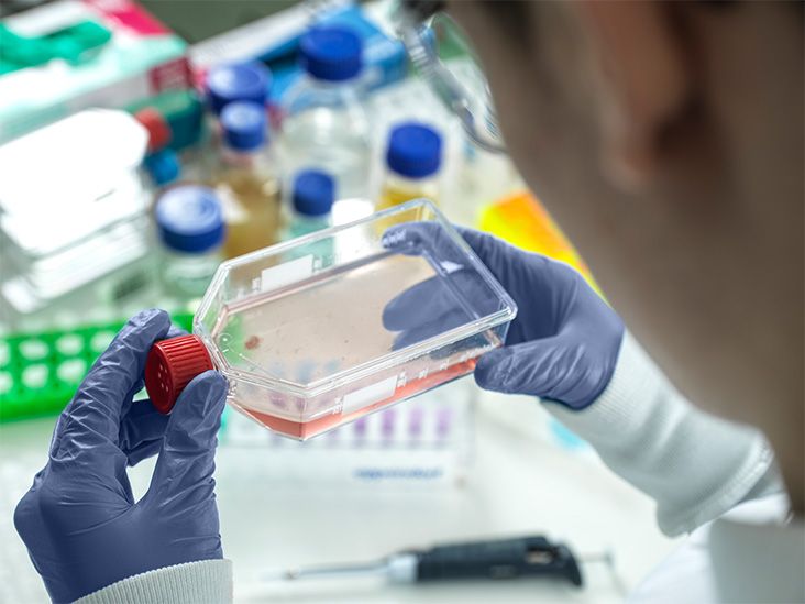 Nueva terapia con células madre podría proteger la cognición en la esclerosis múltiple progresiva