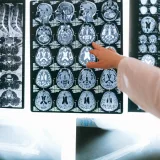 Radiologist pointing at brain MRI scans showing detailed medical examination.
