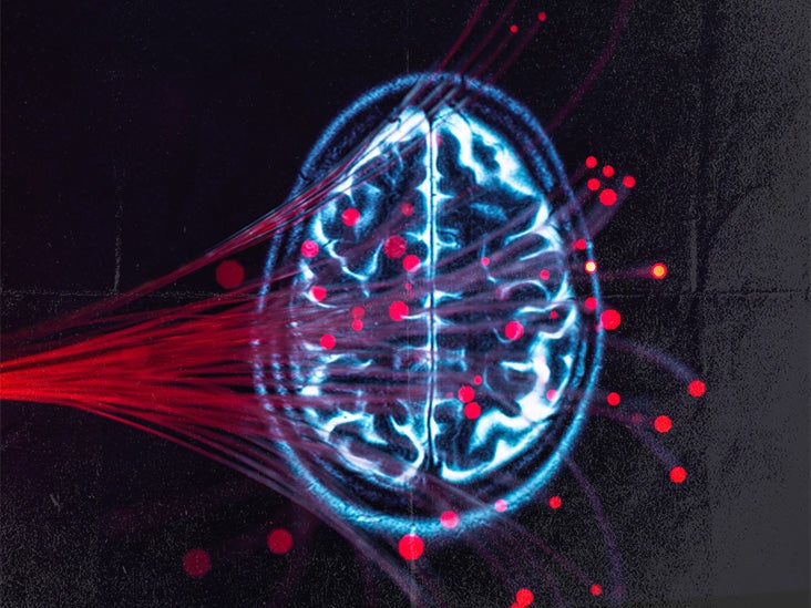 Esquizofrenia: Cómo el crecimiento de los vasos sanguíneos en el cerebro podría ser un factor