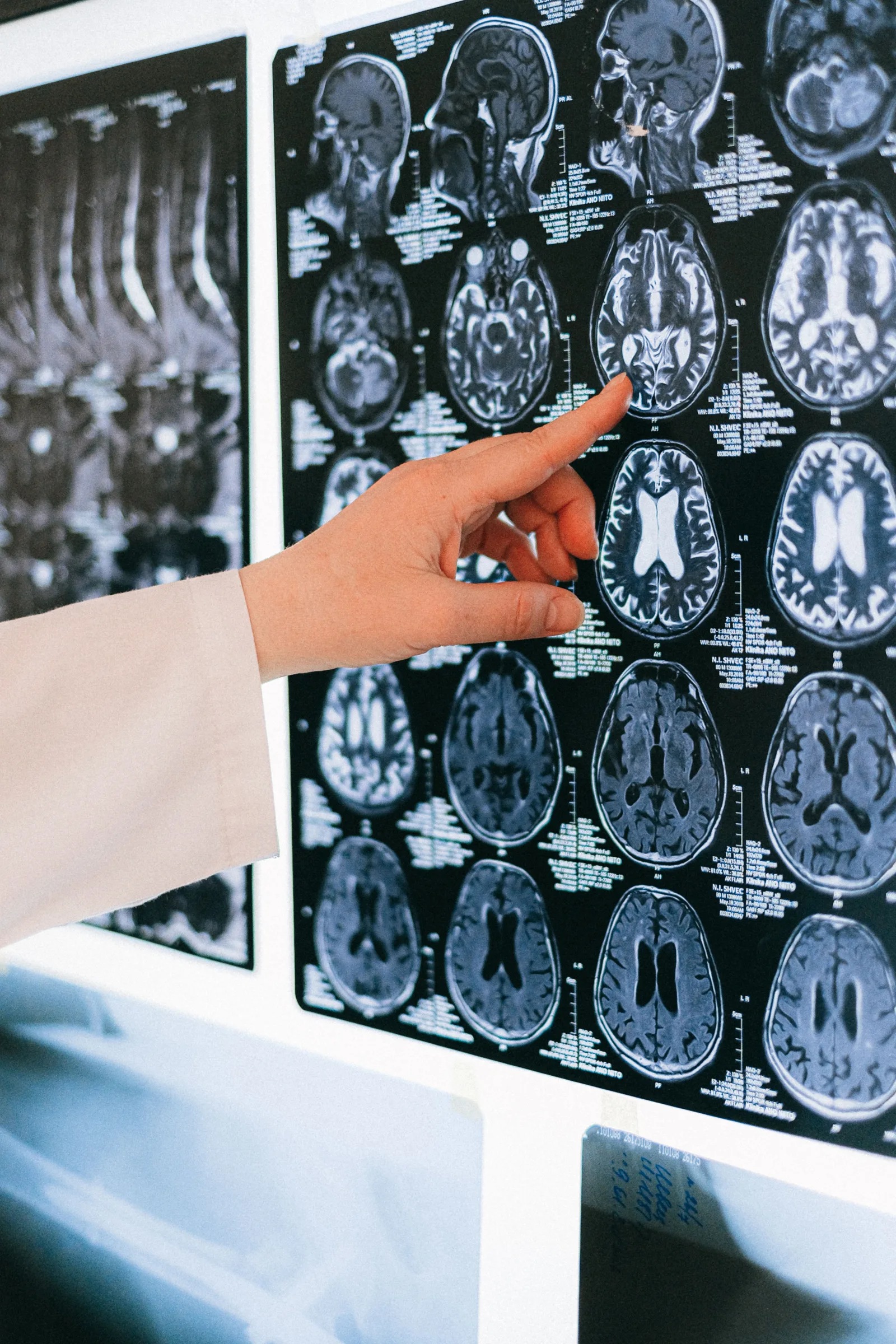La mano de un médico señala una resonancia magnética cerebral en un negatoscopio, ilustrando el diagnóstico médico.