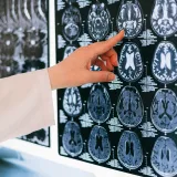 La mano de un médico señala una resonancia magnética cerebral en un negatoscopio, ilustrando el diagnóstico médico.