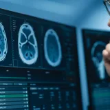 Vorasidenib controla el glioma en 96% de 58 pacientes