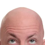 Pastilla contra la alopecia reporta resultados en estudio avanzado
