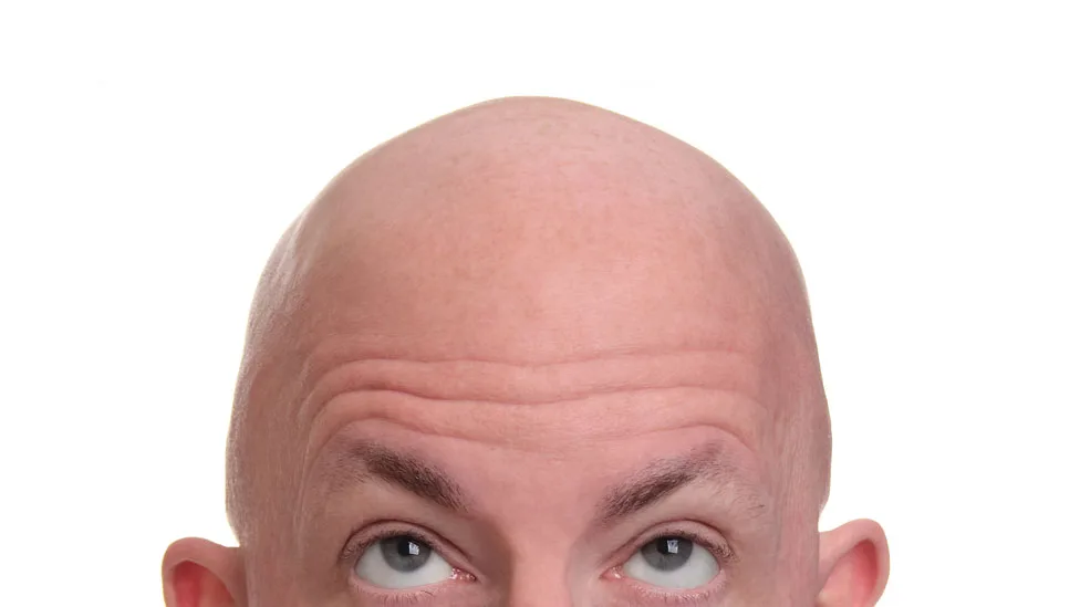 Pastilla contra la alopecia reporta resultados en estudio avanzado