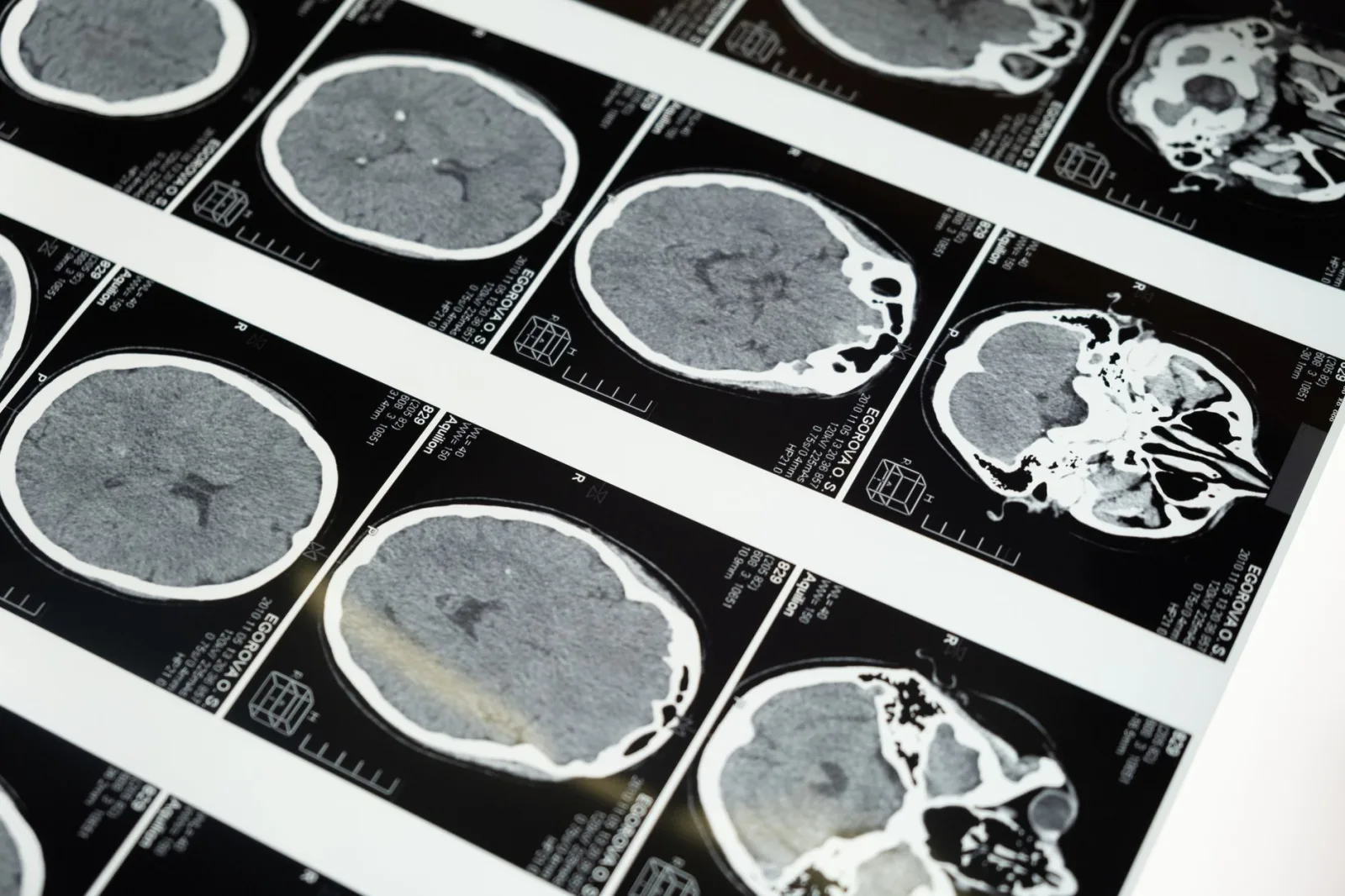 Exploraciones detalladas de resonancia magnética cerebral mostradas en una caja de luz, que ilustran técnicas de diagnóstico por imágenes.