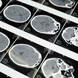 Exploraciones detalladas de resonancia magnética cerebral mostradas en una caja de luz, que ilustran técnicas de diagnóstico por imágenes.