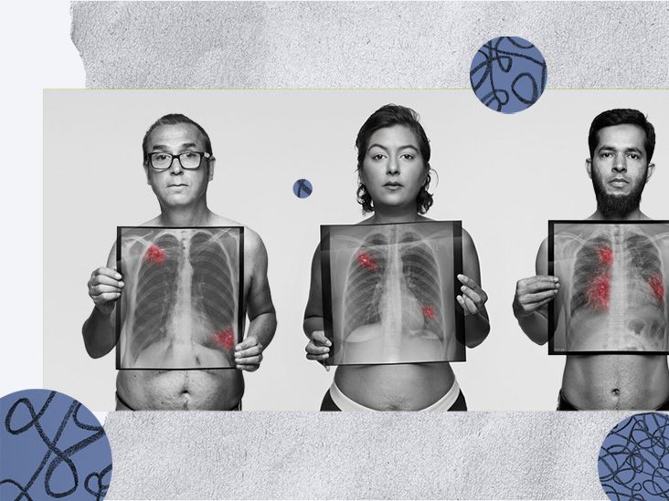 No solo una enfermedad de fumadores: Rompiendo el estigma del cáncer de pulmón