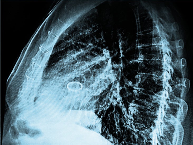 Cómo la cirugía de TAVR mínimamente invasiva podría beneficiar a personas con estenosis aórtica